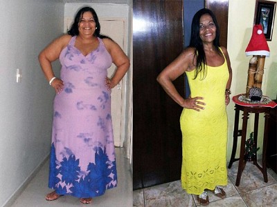 CIRURGIA BARIÁTRICA SALVA MULHER DO CÂNCER
